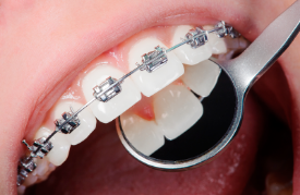 矯正装置が気になる